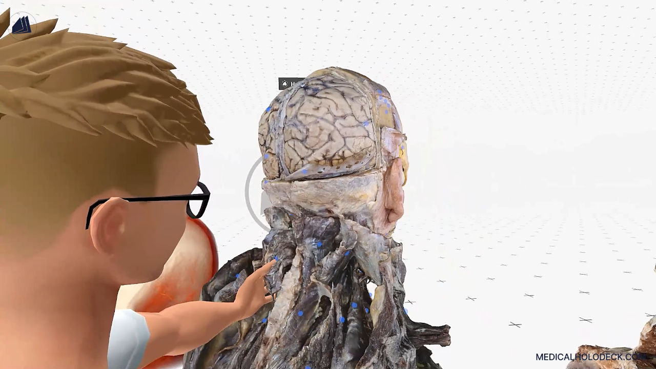 Brain aneurysms - the silent threat thumbnail 2